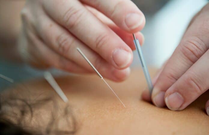 acupuncture,